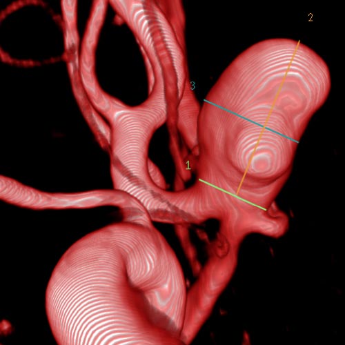 Aneurysma 2 Aneurysma