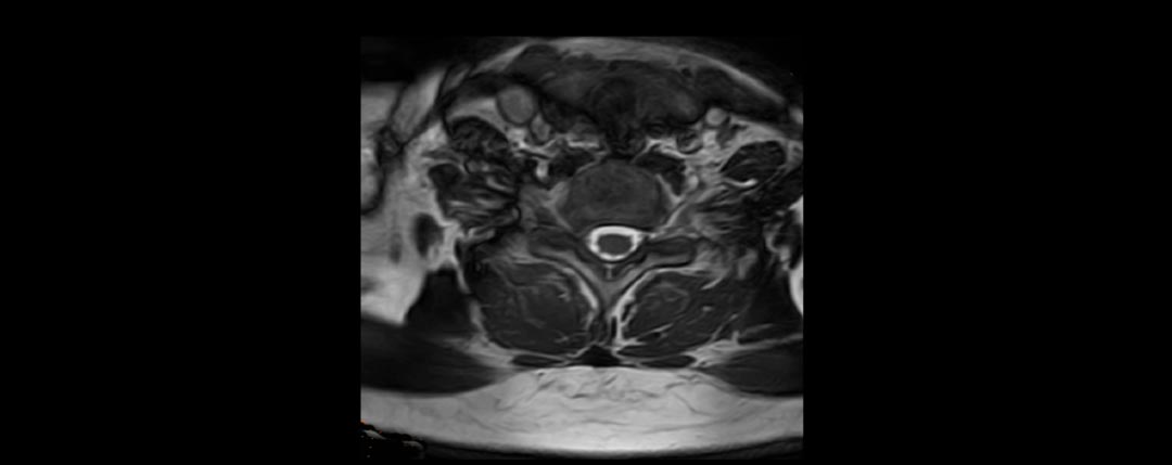 MRT der Halswirbelsäule in T2 Gewichtung und in axialer Aufnahme. Rechter Bandscheibenvorfall
