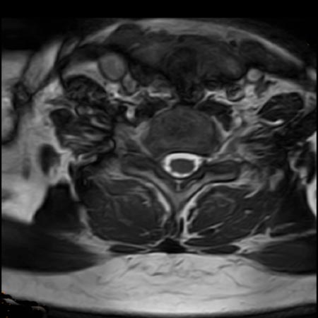MRT der Halswirbelsäule in T2 Gewichtung und in axialer Aufnahme. Rechter Bandscheibenvorfall