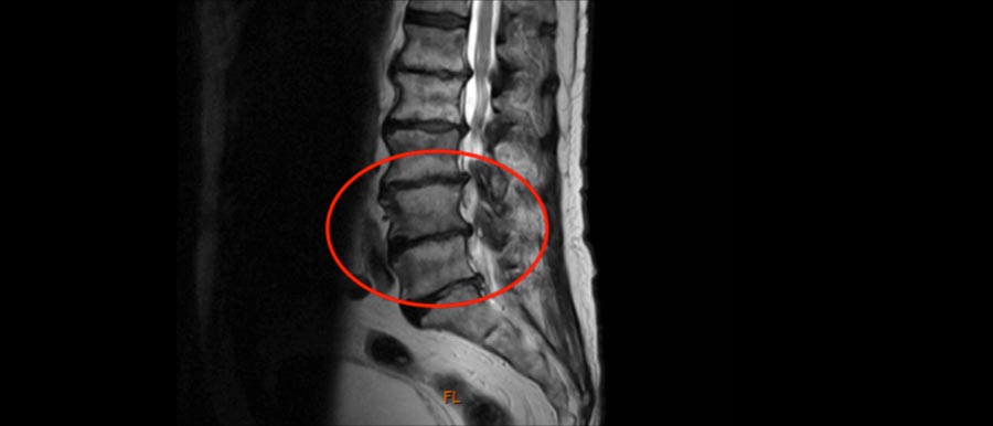 Lumbale Stenose Neurochirurgin Dr. Unterhofer Innsbruck